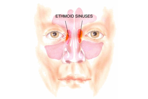 sinus infection nose